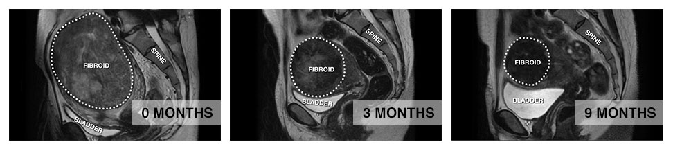UFE Procedure - 0-9 Months Progress